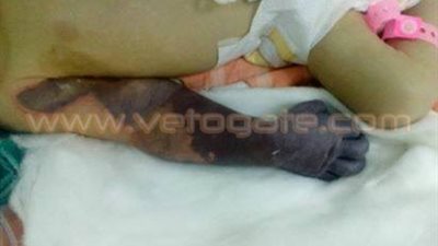 الإهمال الطبي بكفر الشيخ يودي بحياة طفل وإصابة آخر بضمور في المخ