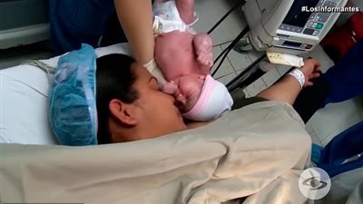 حالة نادرة لطفلة تولد بداخلها توأمها (صور)