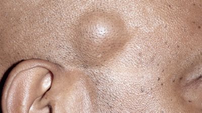 أسباب تكون «الكيس الدهنى» وطرق العلاج الطبيعية