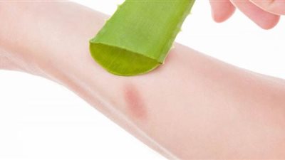 3 مواد موجودة في مطبخك لعلاج الحروق بسرعه