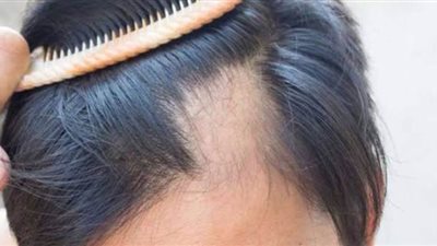 روشتة هاني الناظر لعلاج الثعلبة عند الأطفال والكبار