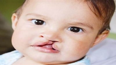 العمر المناسب لإجراء جراحة الشفة الأرنبية للطفل