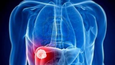 اعراض دهون الكبد وطرق التشخيص والعلاج