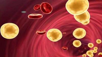 اسباب واعراض ارتفاع الكوليسترول بالدم