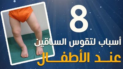8 أسباب لتقوس الساقين عند الأطفال | إنفوجراف