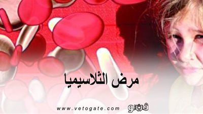 مرض الثلاسيميا | ينتقل بالوراثة ويسبب فقر الدم
