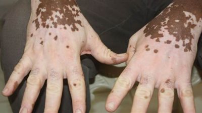 هاني الناظر: من السهل علاج مرض البهاق| فيديو