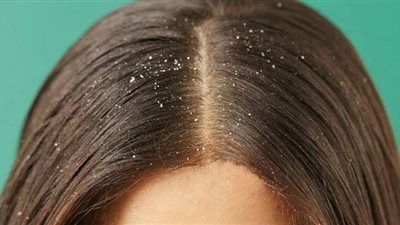 3 وصفات سريعة وغير مكلفة لعلاج قشرة الشعر