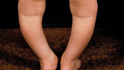 نقص الكالسيوم عند الأطفال | تكرار حوادث الكسور أهم أعراضه