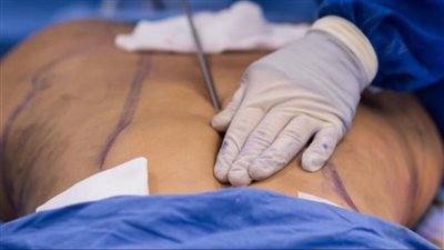 المرشحون لعملية شد البطن وما أهميتها.. استشاري يوضح