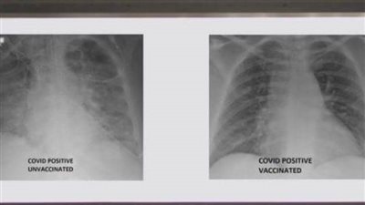  صور أشعة توضح الفرق بين رئتي شخص مطعم ضد كورونا وآخر غير محصن
