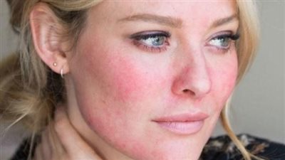 أسباب وأعراض الذئبة الحمراء.. وإليك طرق العلاج