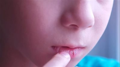 شاهد.. كل ما تريد معرفته عن فيروس الهربس المنتشر بين الأطفال وطرق العلاج 