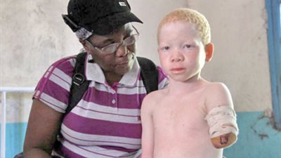 بالصور.. 10 معلومات عن «الألبينو» أعداء الشمس.. التعرض للشمس مباشرة يحرق جلدهم.. يصابون برعشة في العينين وضعف في الرؤيا.. قتل 72 ألف طفل بتنزانيا لعلاج الضعف الجنسي.. وقدراتهم السحرية خرافات