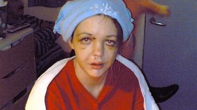 امرأة تفقد جبهتها بسبب أمر يفعله الكثيرون يوميا (صور)