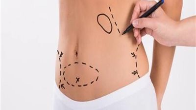 تعرفي على أحدث تقنية في العالم لشفط الدهون