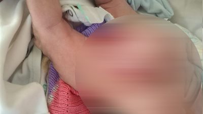 استئصال ورم يزن ٤ كيلو من طفلة بمستشفى التأمين الصحي ببنها (صور)