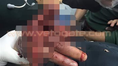 بالصور.. انفجار يد شاب بالدقهلية خلال إطلاق الألعاب النارية