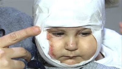بالفيديو.. احتراق وجه طفلة لبنانية بسبب الألعاب النارية