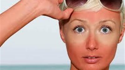 10 علاجات منزلية لحروق الشمس بديل الكريمات والمستحضرات الكيماوية