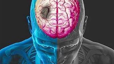 التوصل إلى جين يقلل من تورم المخ بعد السكتة الدماغية