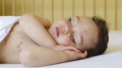 تجنبي مسببات الطفح الجلدي عند طفلك