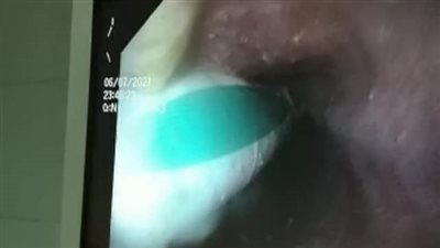 بعد استخراج فرشاة أسنان من مريء مريضة بالمنوفية.. الأطباء يكشفون كيف ابتلعتها؟