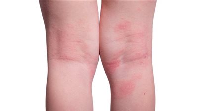 كل ما تودين معرفته عن علاج تسلخات الأطفال 