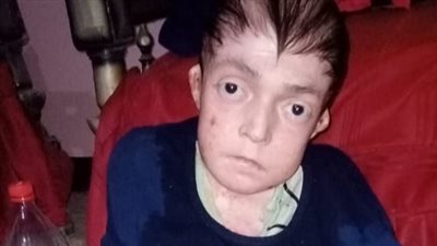 مات أشقاؤه السبعة بنفس السبب.. محمد يعيش وحيدا يصارع مرضا نادرا | فيديو