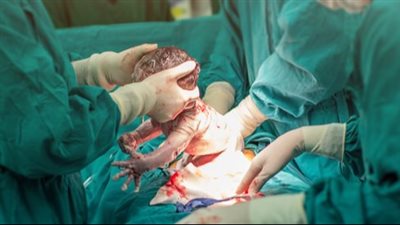 أستاذ نساء وتوليد: 70% نسبة الولادة القيصرية