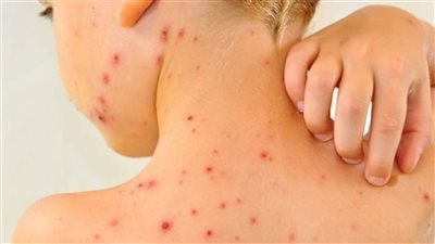 مرض الجدري عند الاطفال الأسباب والأعراض.. وطرق العلاج