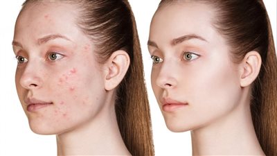 أفضل الوصفات الطبيعية لعلاج البثور في أسرع وقت