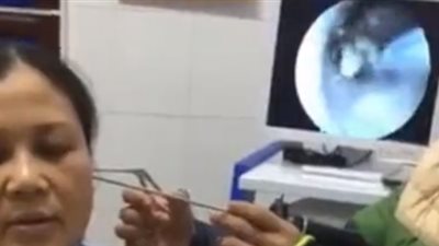 فراشة ترفرف داخل أذن امرأة أثناء إزالتها (فيديو)