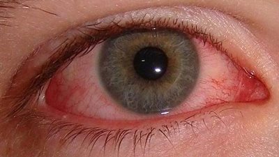 أسباب حساسية العين وطرق العلاج