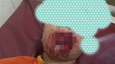 شاهد.. كلب مسعور يعقر 22 شخصا بينهم أطفال وسيدات بقرية إبشواي الملق بالغربية