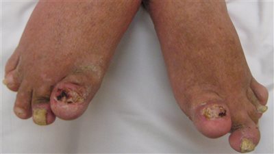 أستاذة الطب الطبيعي تكشف أعراض مرض 