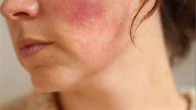 أسباب تصبغ البشرة وحروق الجلد