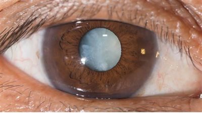 يصيب 90% من الحالات، ما هو مرض تحلل مركز الإبصار لكبار السن؟