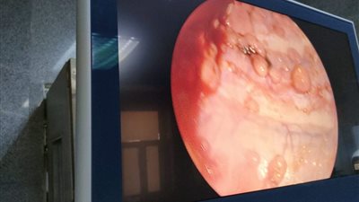 بأحدث التقنيات.. بنها الجامعي تنقذ حياة مسنة مصابة بورم 