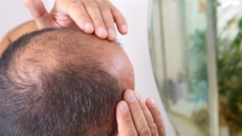تساقط الشعر، فيتو