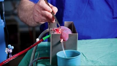 ثورة علمية تنقذ الملايين.. نجاح تغيير فصيلة دم 