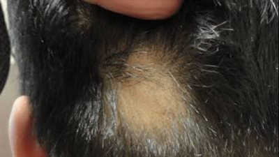 هل ينمو الشعر مرة أخرى بمرض الثعلبة وما هي أعراضه؟