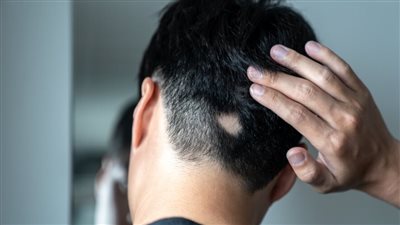 ما هو مرض الثعلبة.. وأهم أعراضه