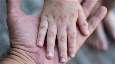 منظمة الصحة العالمية: فيروس جدري القرود لم يتحول إلى وباء حتى الآن