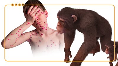 208 إصابات بجدري القرود في إسرائيل