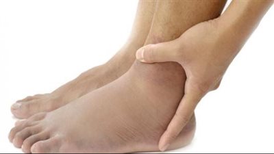 أسباب وأعراض تورم القدمين وطرق العلاج