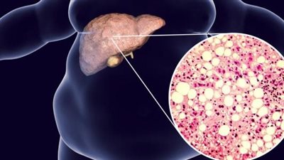 أعراض الكبد الدهني غير الكحولي والنظام الغذائي المناسب للمرضى