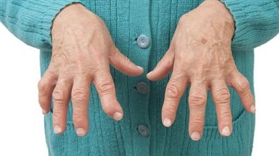 أعراض مرض الروماتويد وأسبابه.. وطرق العلاج
