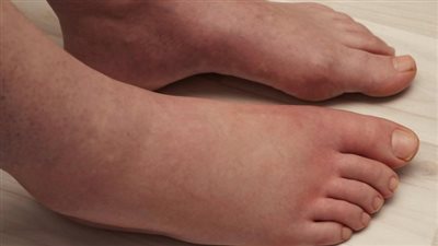 علاقة تورم القدمين بارتفاع حرارة الطقس