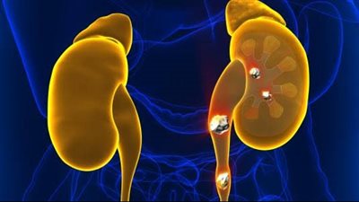 هل يعد وجود دم في البول علامة على الإصابة بحصوات الحالب؟